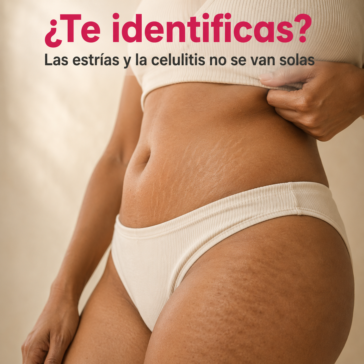 Estrías y celulitis — el problema